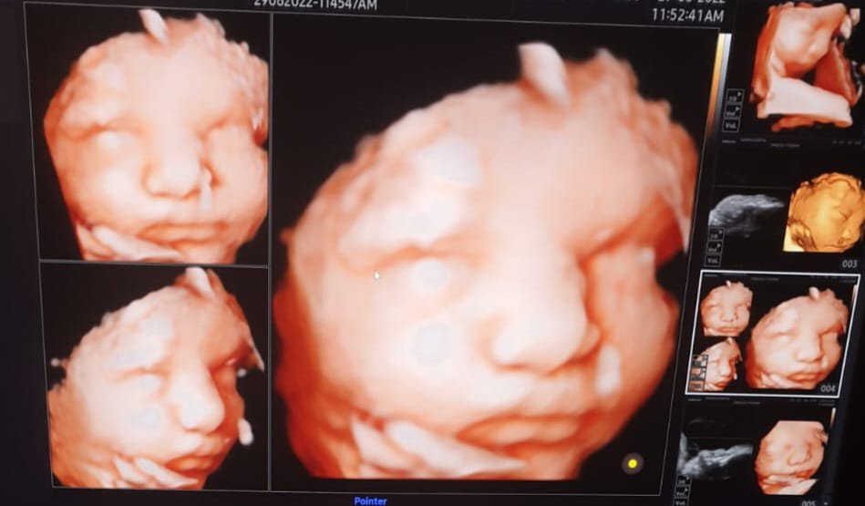Caesarean Section in Gota, Ahmedabad
