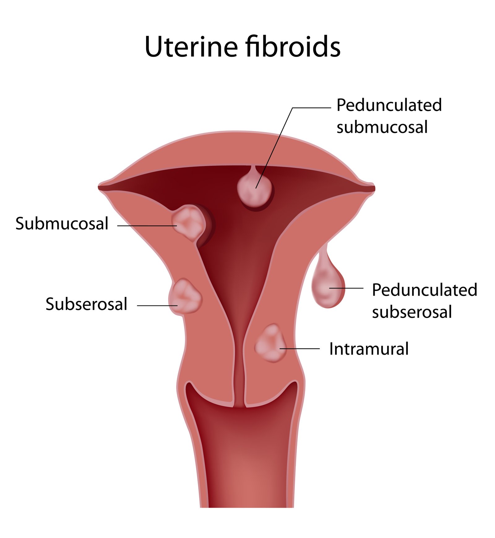 Fibroid Treatment in Gota, Ahmedabad