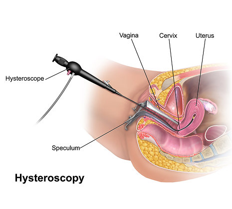 Hysteroscopy in Gota, Ahmedabad