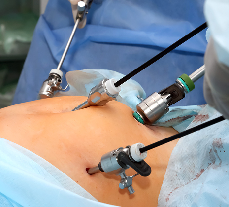 Laparoscopic Hysterectomy in Gota, Ahmedabad