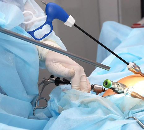 Laparoscopic Ovarian Surgery in Gota, Ahmedabad