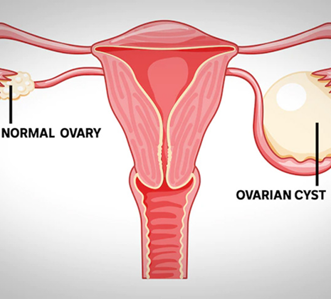 Ovarian Cyst Treatment in Gota, Ahmedabad